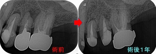 根管治療で使用する綿栓（わた） - EE DENTAL_Blog